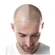 Haarmikropigmentierung
